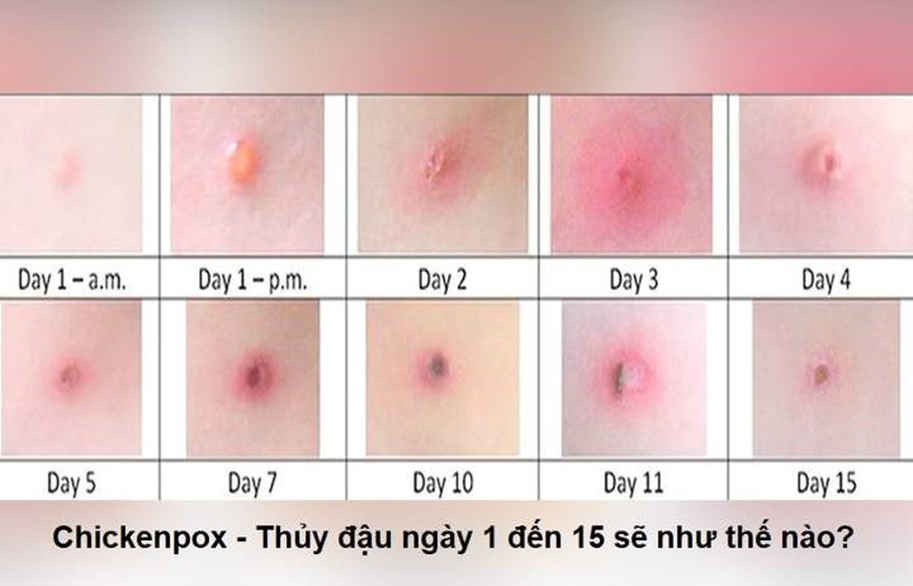 Con có những dấu hiệu này mẹ cần cho con đi khám gấp vì nguy cơ bị thủy đậu - Ảnh 1.