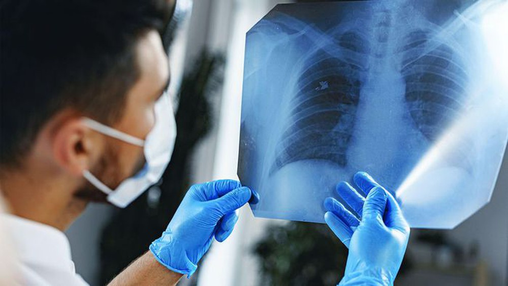3 triệu chứng nghiêm trọng cảnh báo ung thư phổi - Ảnh 4.