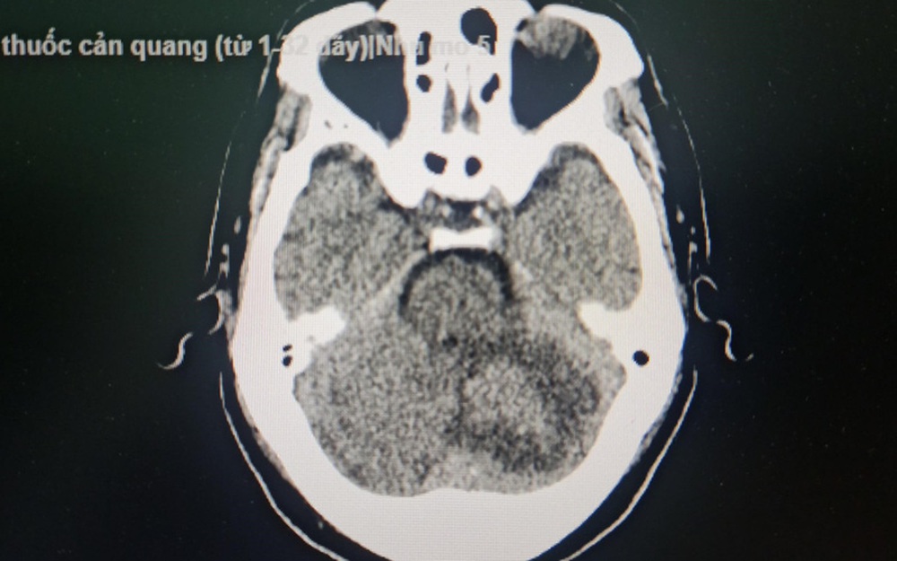 Đột ngột đau đầu, mất cân bằng, đi viện phát hiện khối u não - Ảnh 1.