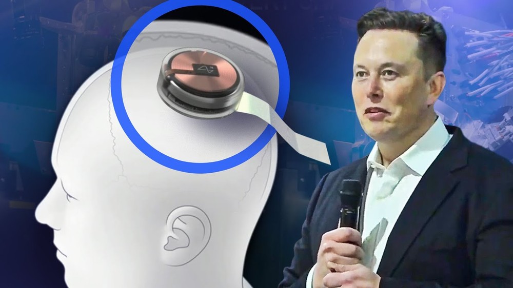 Chip não chữa bệnh của Elon Musk hoạt động như thế nào trong não người - Ảnh 1.