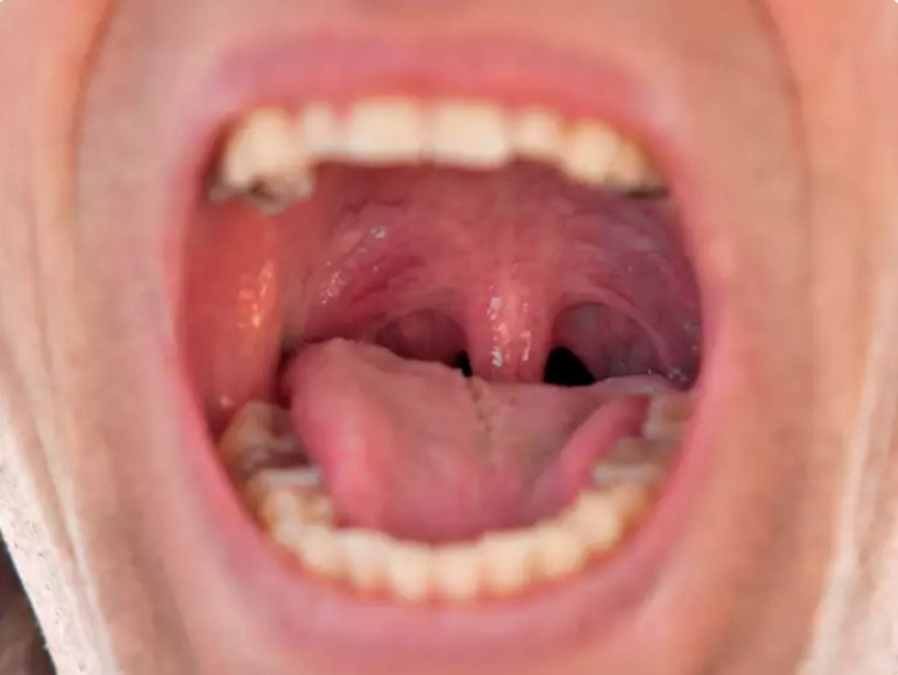6 triệu chứng ung thư thực quản ở cổ họng - Ảnh 1.