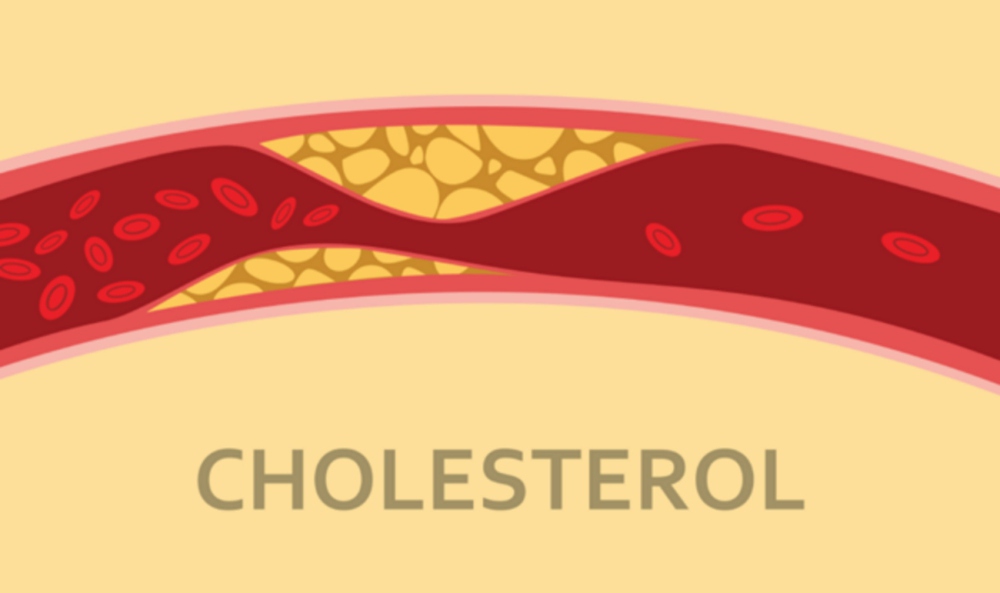 Dấu hiệu ở chân cảnh báo cholesterol cao mà bạn cần đi khám ngay - Ảnh 7.