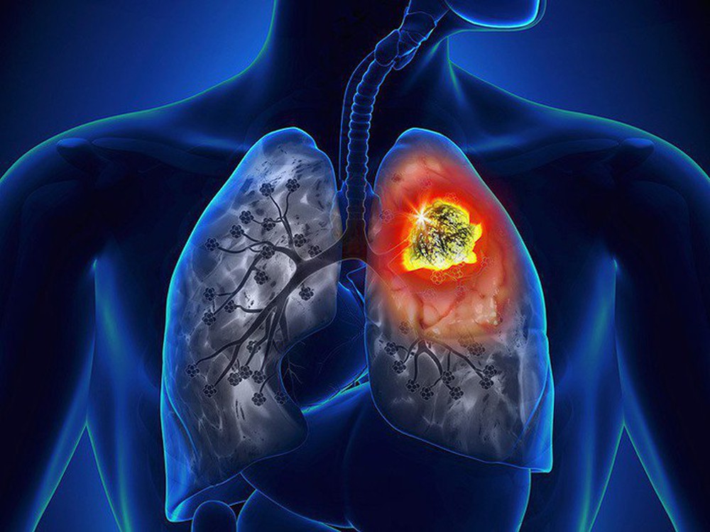 Người đàn ông phát hiện mắc ung thư phổi sau khi có 4 dấu hiệu bất thường - Ảnh 1.