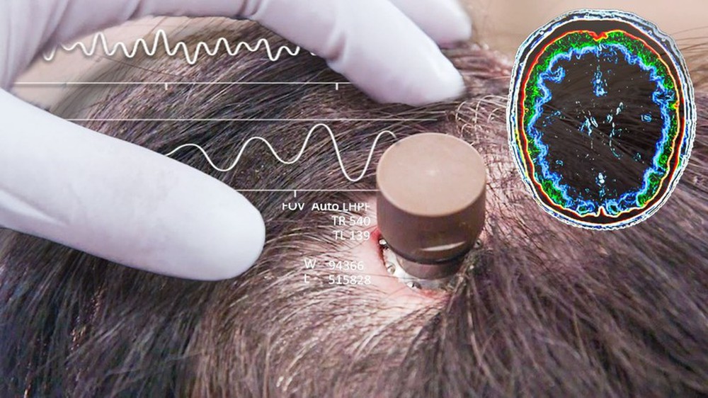 Công nghệ cấy chip vào não người - Ảnh 4.