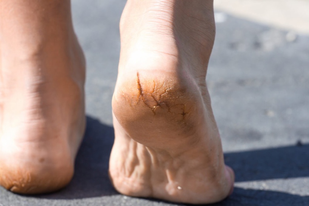 Dấu hiệu ở bàn chân chứng tỏ bạn đang có đường huyết quá cao - Ảnh 1.