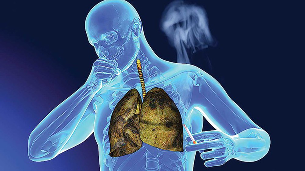 7 đối tượng nên tầm soát ung thư phổi hàng năm - Ảnh 1.