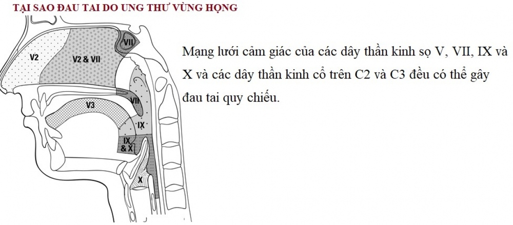 Lưu ý đau tai rất có thể là dấu hiệu của ung thư vùng họng - Ảnh 1.