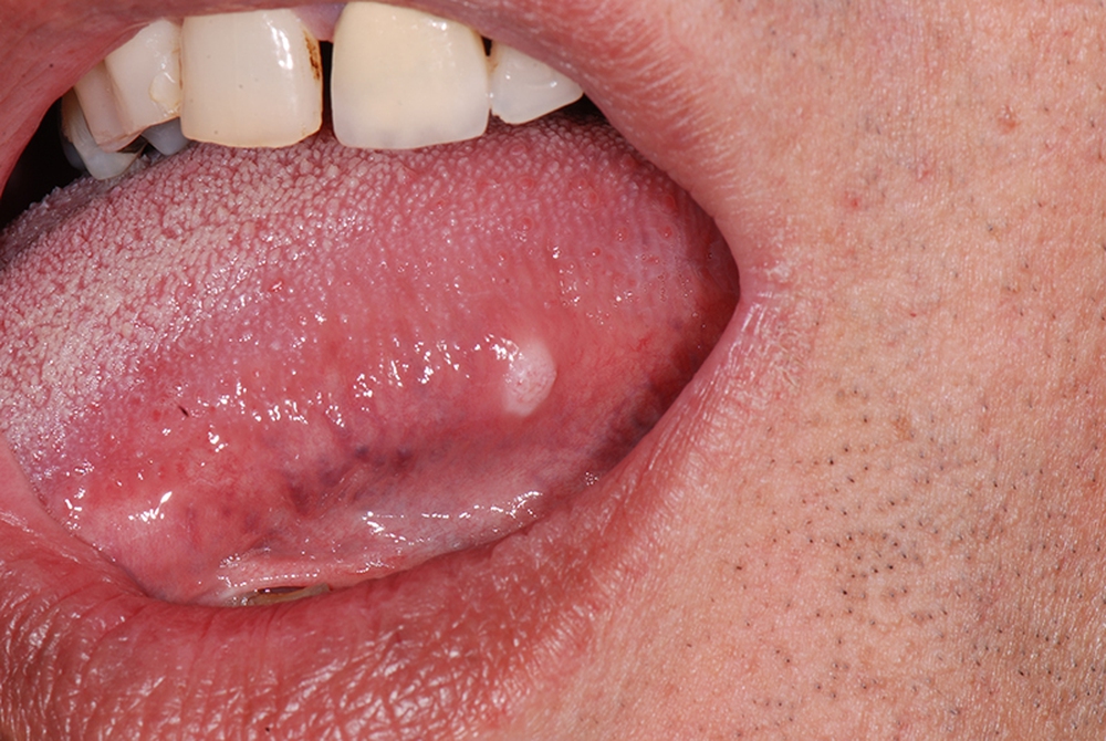 Đi khám vì có dấu hiệu lạ trong miệng, không ngờ nguyên nhân là ung thư - Ảnh 1.