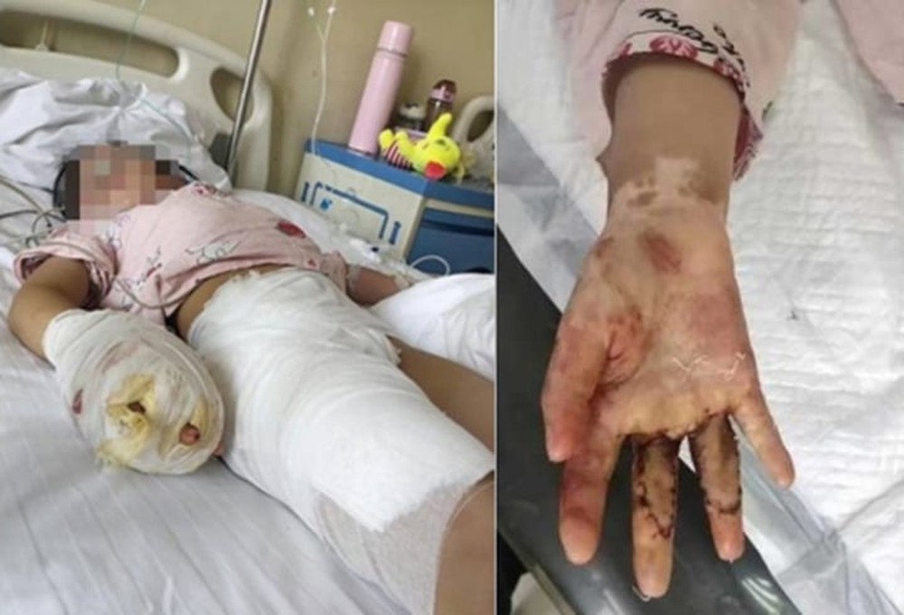Cãi nhau với chồng, mẹ kế hành hạ con chồng đến mức tàn tật
