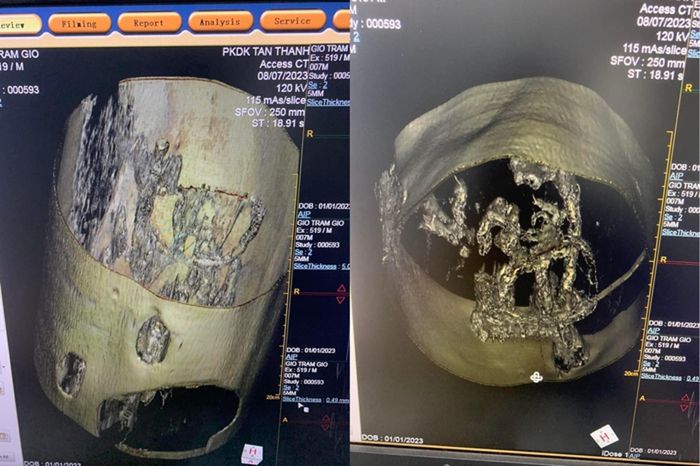 Nhóm người đưa cả cây dó trầm vào chụp cắt lớp CT - Ảnh 3.