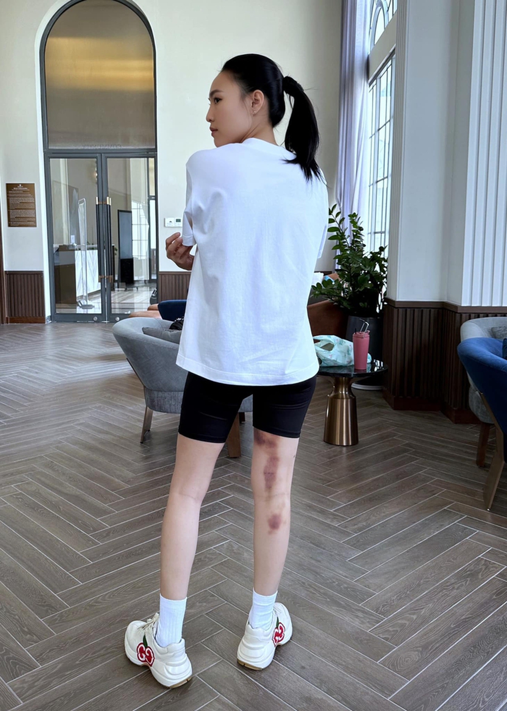Ninh Dương Lan Ngọc khiến fan lo lắng khi lộ vết bầm tím lớn ở chân - Ảnh 1.