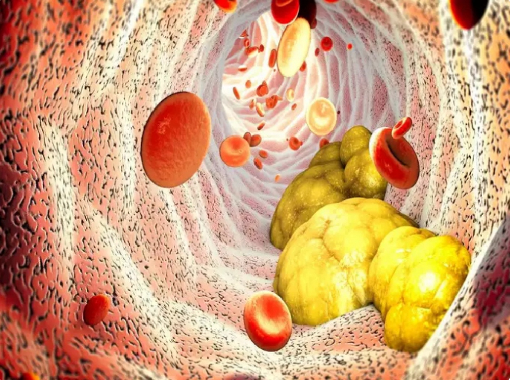 Dấu hiệu ít ai biết về cholesterol cao thông qua đôi tai - Ảnh 3.