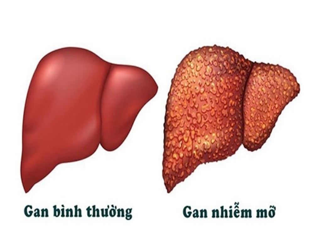 Dấu hiệu ở miệng cảnh báo gan nhiễm mỡ - Ảnh 1.