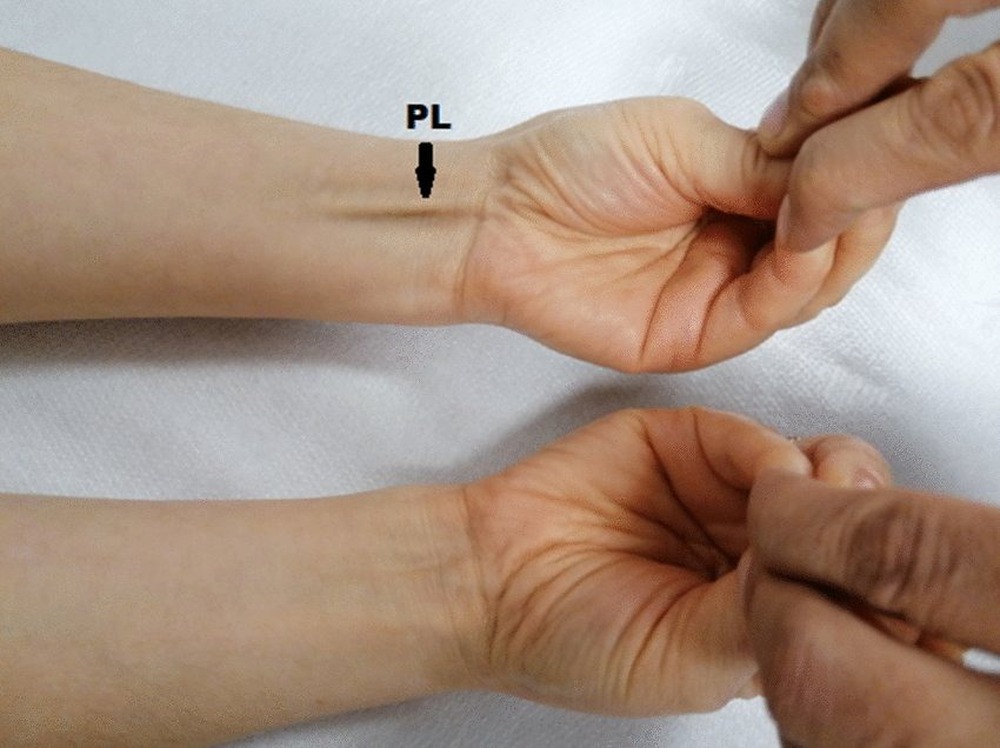 Tại sao một số người không có cơ palmaris longus? - Ảnh 5.