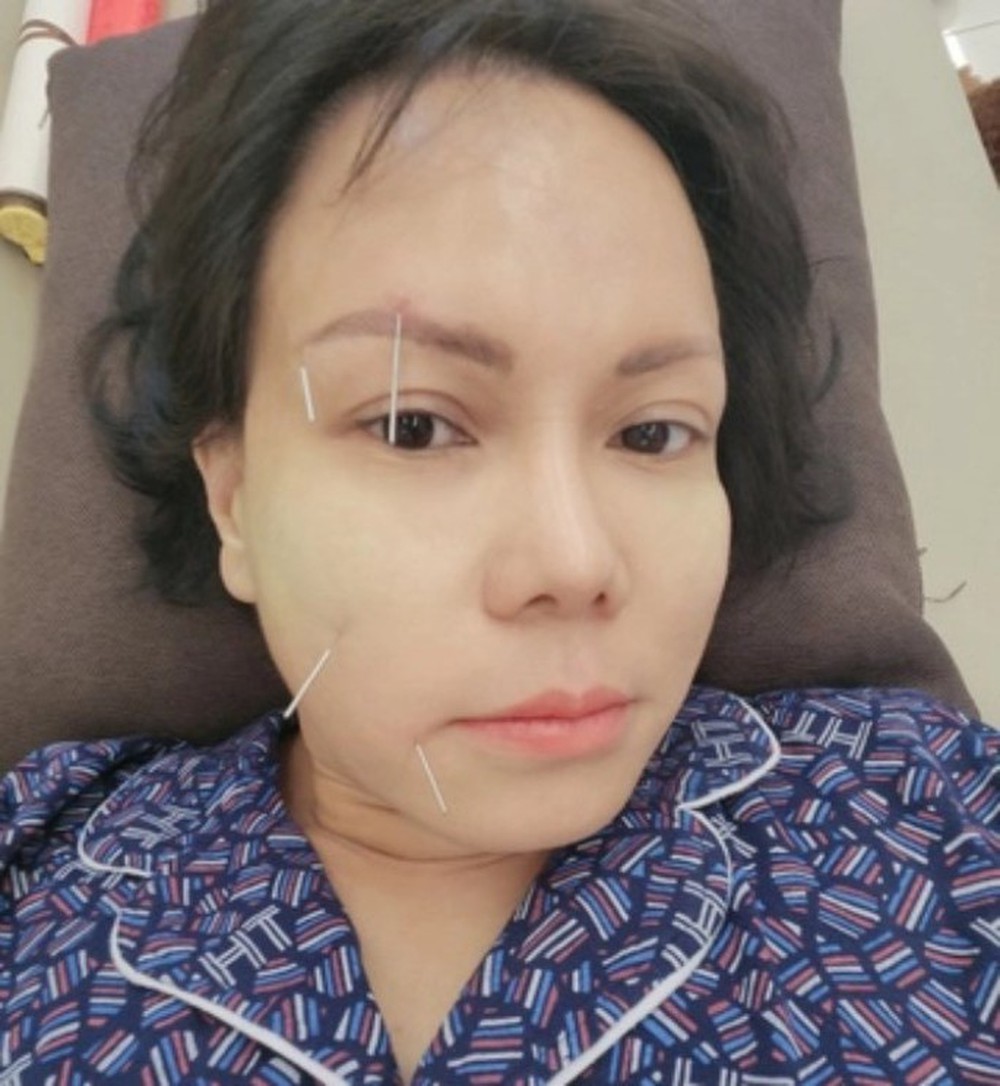 Vài sao Việt không may bị liệt nửa mặt, có người đứng trước nguy cơ đột quỵ - Ảnh 2.