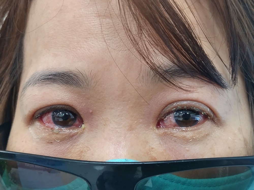 Người bệnh đau mắt đỏ cần làm gì và những lưu ý khi sử dụng thuốc nhỏ mắt - Ảnh 1.