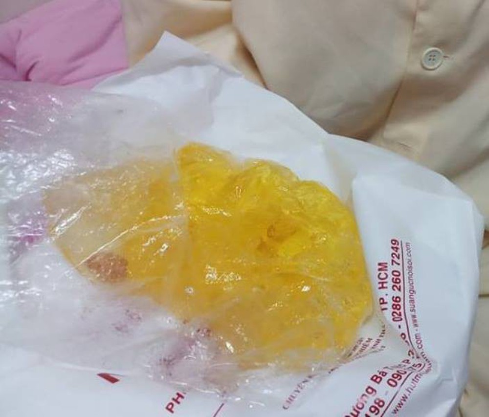 Thực hư túi độn ngực bị vỡ do áp suất trên máy bay  - Ảnh 1.