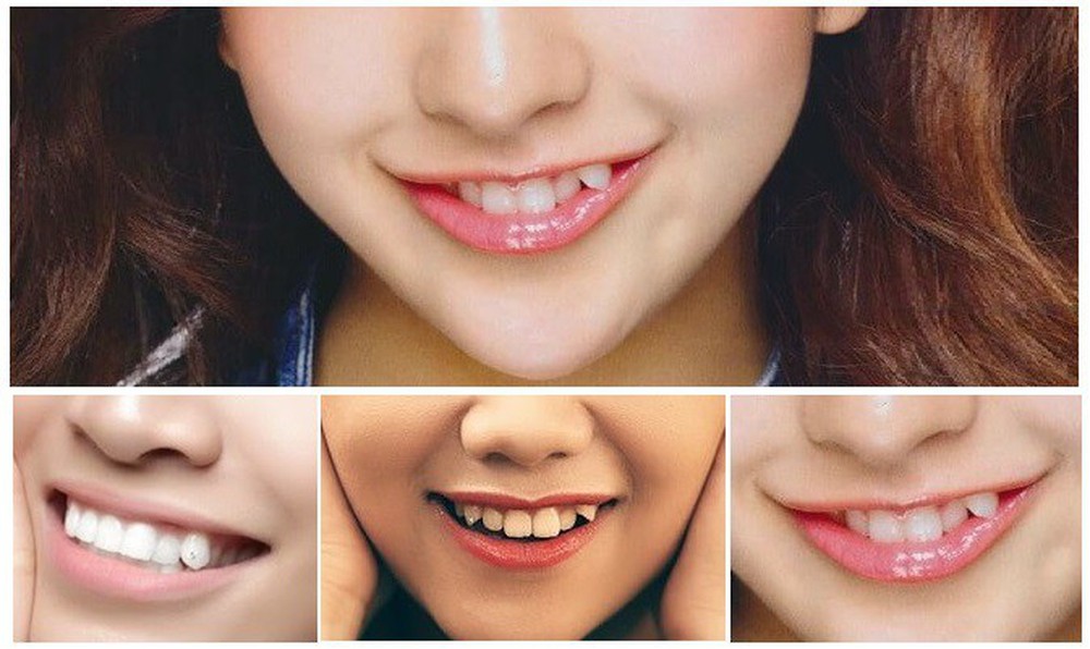 Làm răng khểnh thẩm mỹ để nụ cười thêm xinh được không ? - Ảnh 2.