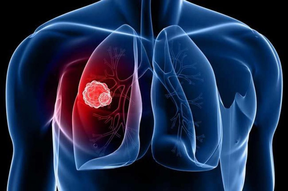 5 giải pháp đơn giản nhất để ngăn ngừa ung thư phổi: Mỗi người đều nên áp dụng sớm - Ảnh 1.