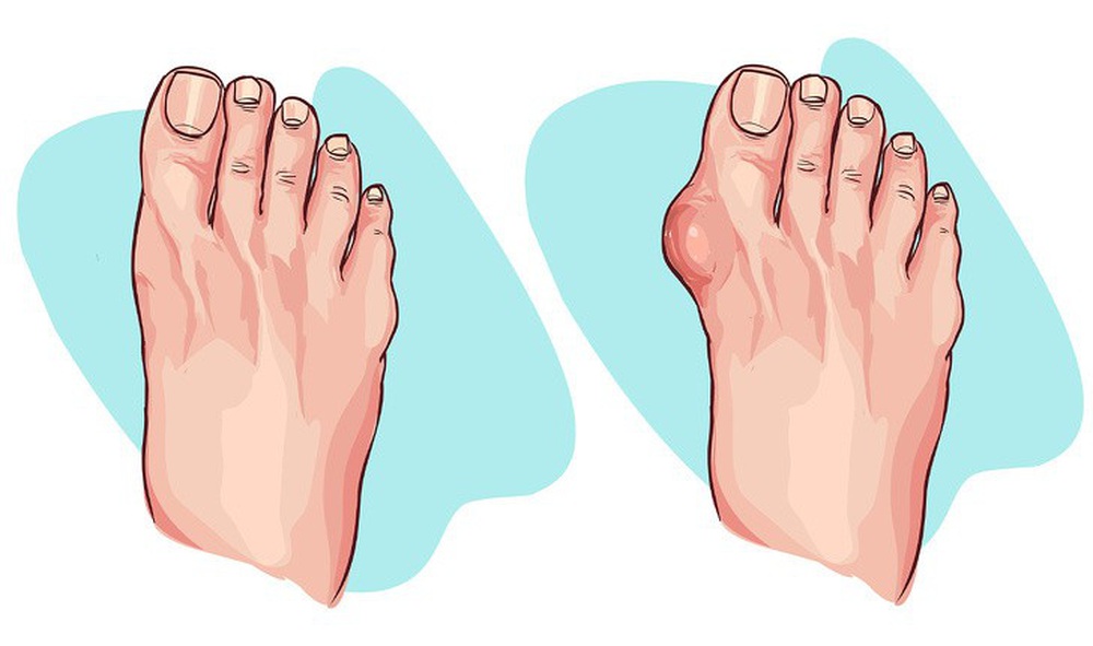 Ngoài bàn chân, 3 bộ phận cơ thể này cũng tổn thương vì giày cao gót - Ảnh 4.