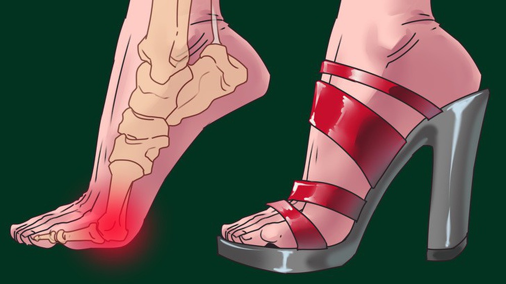 Ngoài bàn chân, 3 bộ phận cơ thể này cũng tổn thương vì giày cao gót - Ảnh 6.