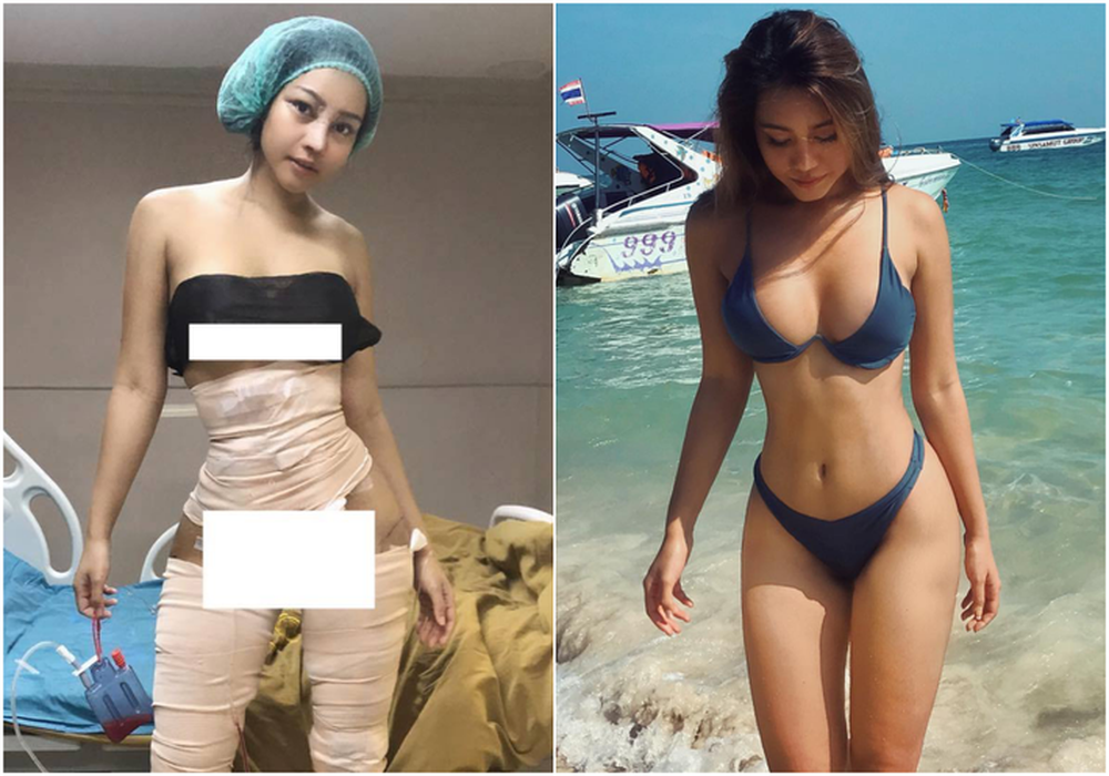 Hot girl bốc lửa Thái Lan bất ngờ công khai ảnh phẫu thuật để có eo con kiến, điều đáng nói đây không phải lần đầu cô lột xác - Ảnh 1.