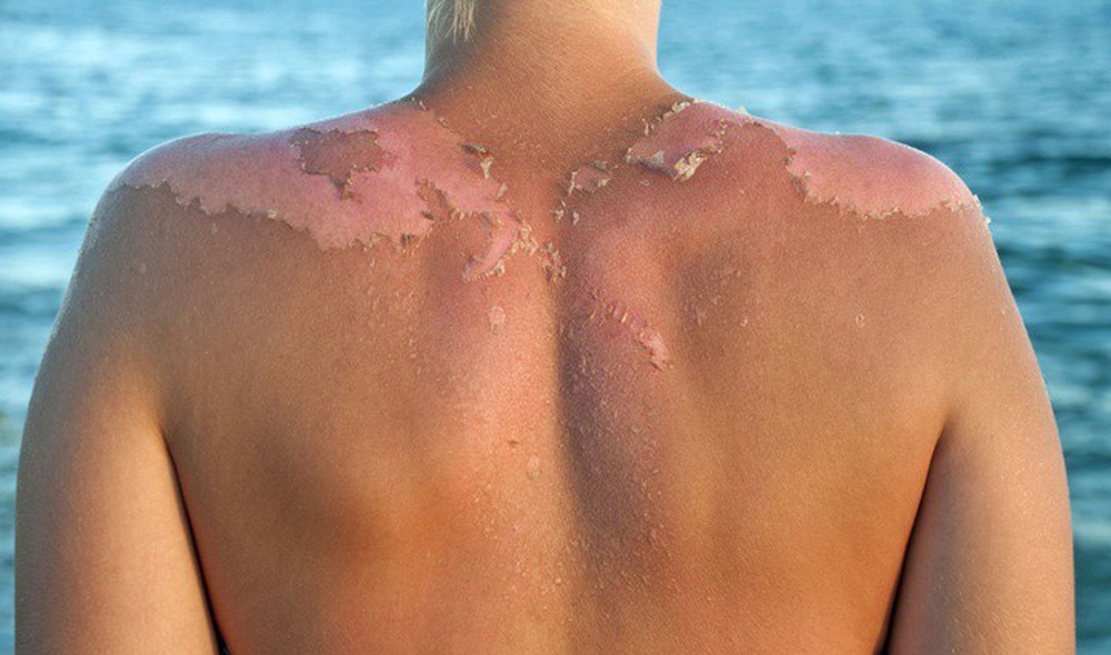 Điều gì làm cho làn da của bạn đỏ sau khi bị cháy nắng? - Ảnh 2.