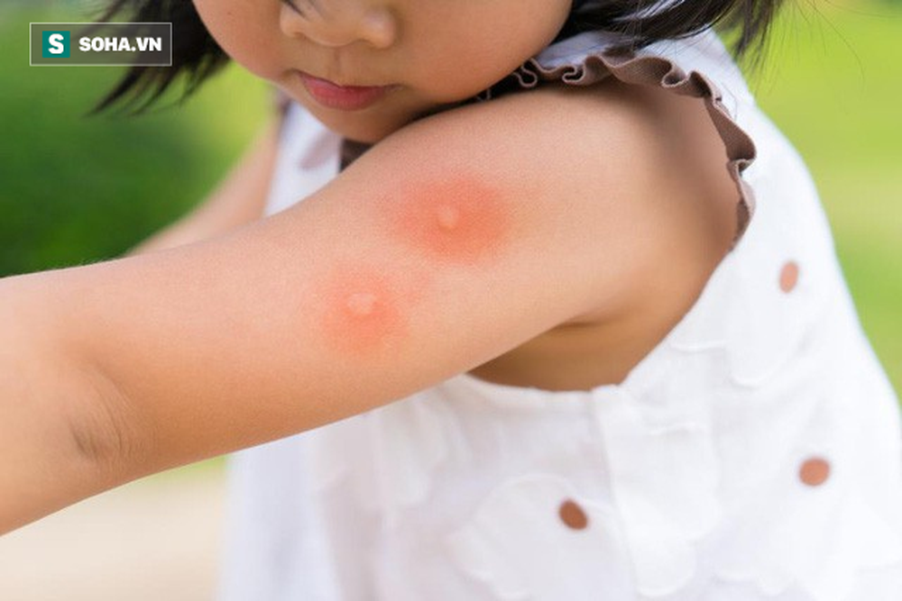 10 cách trị vết muỗi đốt ngay tức thì mà không cần bôi thuốc - Ảnh 1.