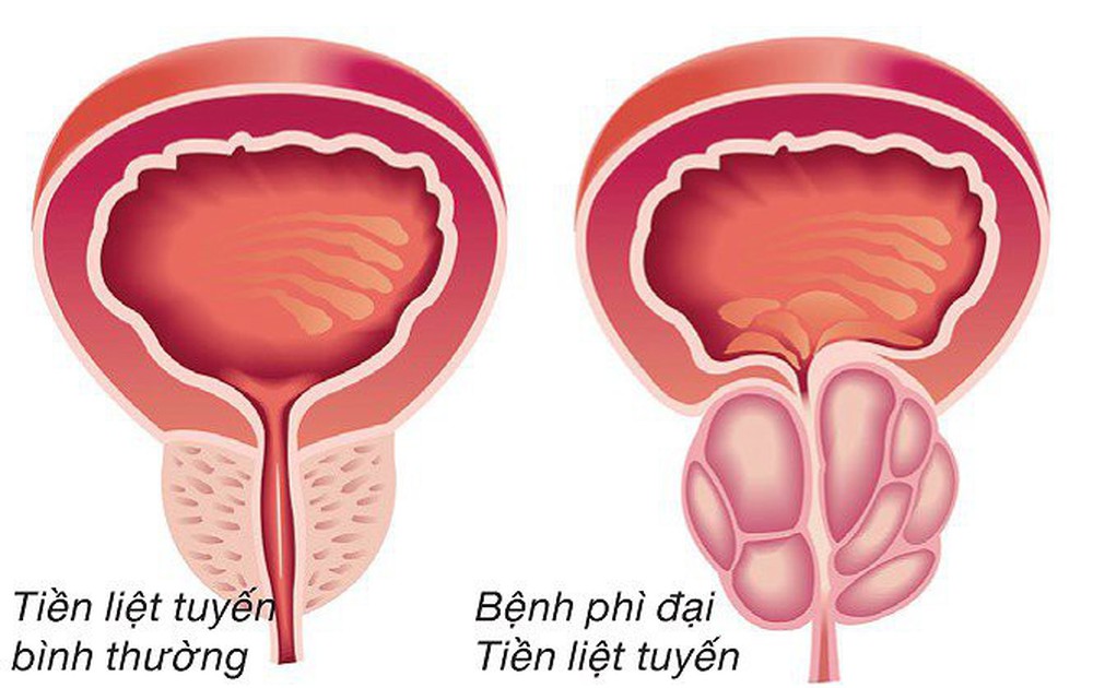 Chuyên gia lý giải nguyên nhân gây phì đại tuyến tiền liệt ở nam giới, triệu chứng và phương pháp điều trị - Ảnh 1.