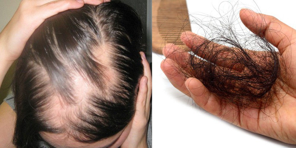 Những sai lầm khi điều trị rụng tóc và lời khuyên của chuyên gia da liễu giúp khắc phục toàn diện, lâu dài - Ảnh 1.