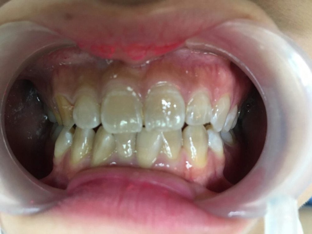 Chân răng bị đen có nguy hiểm không: Giải pháp làm trắng và ngăn ngừa răng xỉn màu - Ảnh 2.