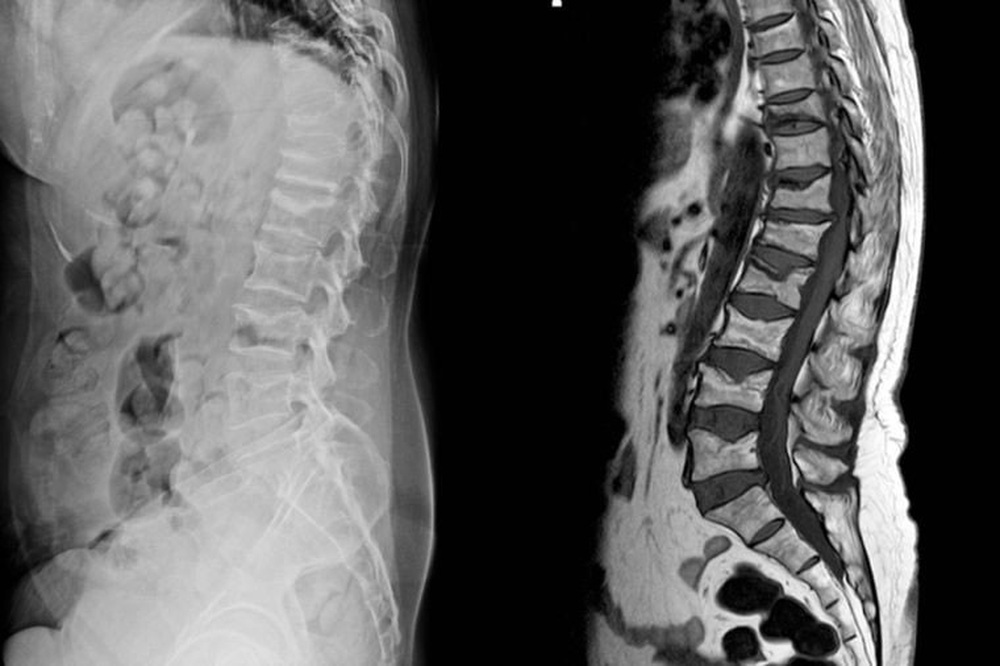 7 bệnh nghiêm trọng sau dấu hiệu của cơn đau lưng - Ảnh 3.