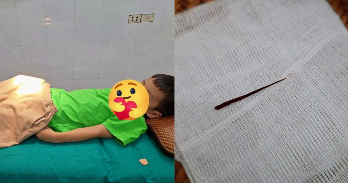Con trai chịu đau cả buổi chiều không dám báo cô: Bố mẹ đưa đi viện mới lo lắng với chiếc dằm rút ra từ đùi con