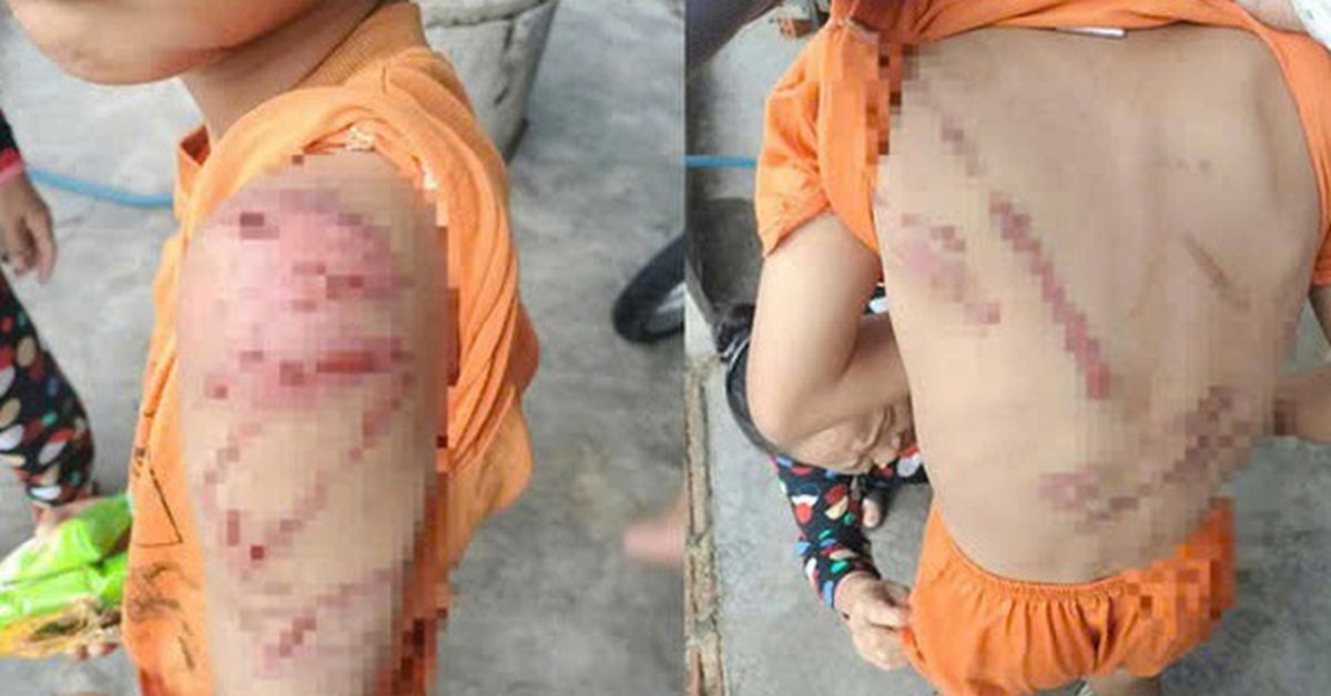 Lý do người cha đánh con 10 tuổi bầm tím khắp người