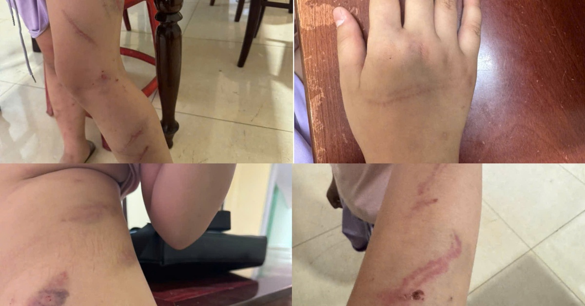 Xác minh vụ bé gái 9 tuổi có 34 vết bầm nghi bị bạo hành ở Đắk Lắk
