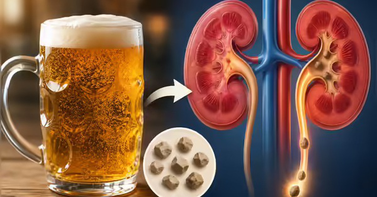 Uống bia giúp đào thải sỏi thận?