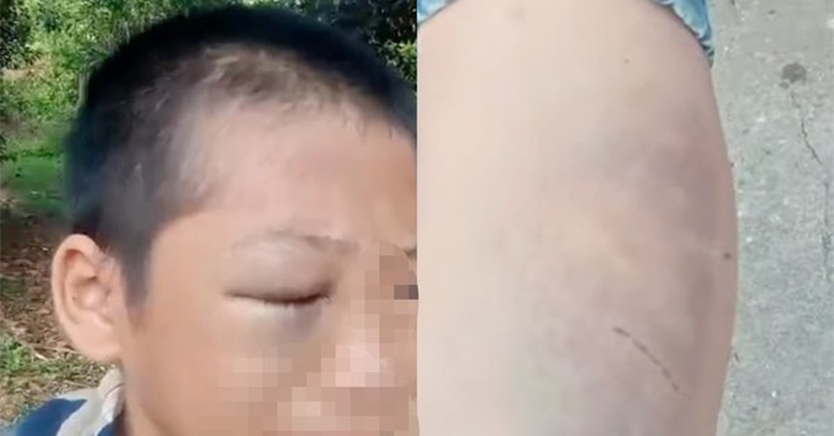 Xôn xao clip bé trai mắt bầm tím, khóc kêu cứu vì nhiều lần bị đánh đập khi ở cùng bố và vợ mới