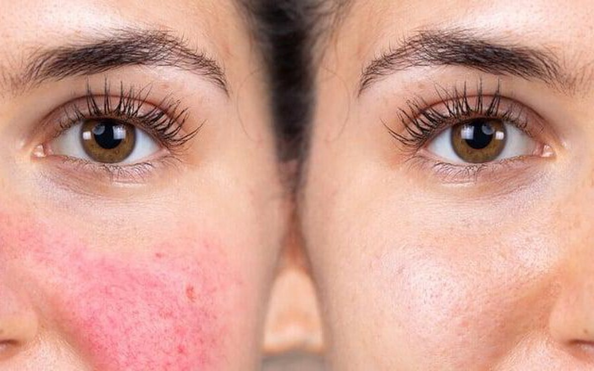 Hydroquinone - Trắng hồng nhanh nhưng chưa chắc an toàn