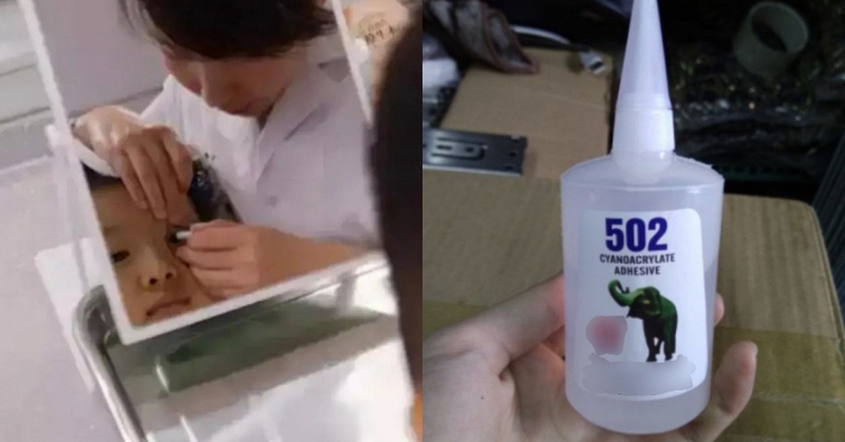 Cậu bé 3 tuổi bắt chước bà nhưng nhỏ nhầm keo 502 vào mắt: Mẹ sơ cứu trong 15 phút, bác sĩ nói "không cần điều trị nữa