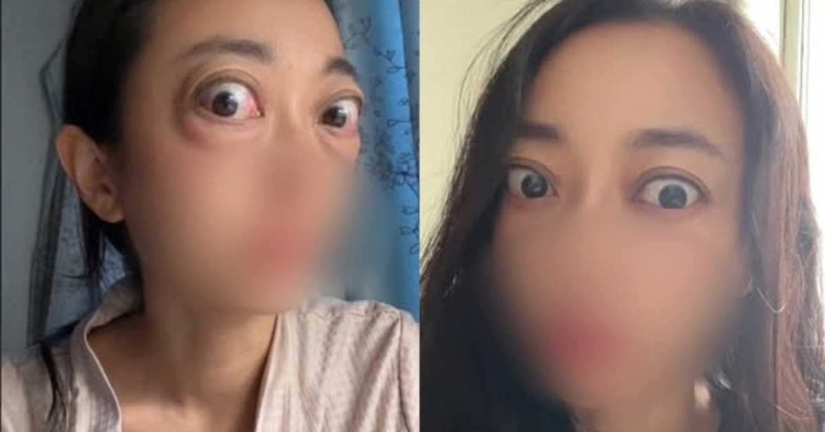 Nhìn đôi mắt "ếch" của người phụ nữ, ai cũng thương, câu chuyện phía sau là bài học cảnh tỉnh nhiều người trẻ