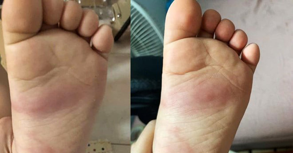 Hưng Yên: Xác minh phản ánh trẻ 3 tuổi bị bầm tím chân sau khi ở trường mầm non về
