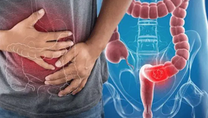 1 dạng ung thư đang tăng mạnh ở người trẻ, nhanh hơn cả ung thư đại trực tràng: Vì sao đáng lo ngại? - Ảnh 3.