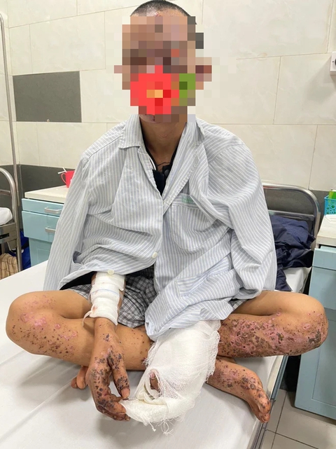 Dùng điện thoại khi đang sạc: Nam thanh niên bị mù mắt, cháy sém toàn thân, thủng màng nhĩ - Ảnh 1. Dùng điện thoại khi đang sạc: Nam thanh niên bị mù mắt, cháy sém toàn thân, thủng màng nhĩ - Ảnh 1.