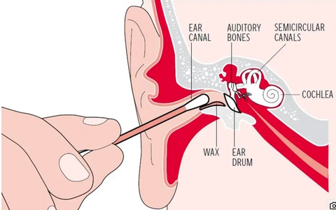 Phải làm gì khi bị ngứa tai? - Ảnh 1. Phải làm gì khi bị ngứa tai? - Ảnh 1.