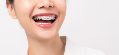 Niềng răng một hàm có được không khi hàm còn lại đã đẹp rồi?- Ảnh 1. Niềng răng một hàm có được không khi hàm còn lại đã đẹp rồi?- Ảnh 1.