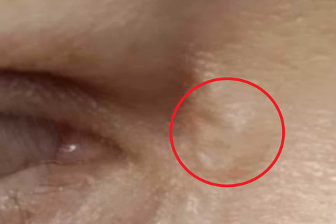 Phát hiện sinh vật lạ sống dưới da qua vết muỗi đốt từ thú cưng - Ảnh 1. Phát hiện sinh vật lạ sống dưới da qua vết muỗi đốt từ thú cưng - Ảnh 1.