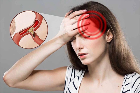 Ngày càng nhiều người bị nhồi máu não: Cảnh giác 3 loại gia vị là 