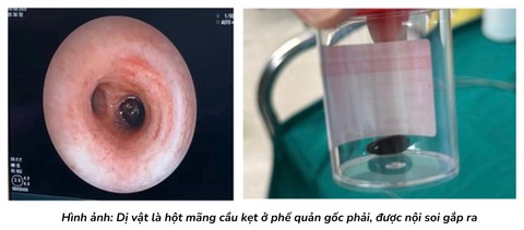 Bé trai Campuchia ho, khó thở 20 ngày không hết: Sang Việt Nam lập tức tìm ra nguyên nhân- Ảnh 1.