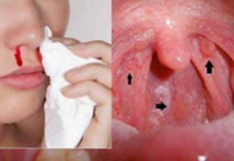 Ung thư vòm họng - 1 bệnh ung thư đứng đầu ở VN: 3 dấu hiệu phát hiện bệnh sớm cần nhớ