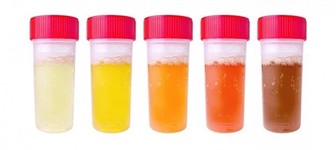 8 dấu hiệu quan trọng nhất cảnh báo thận bị nhiễm độc nặng: Cần phát hiện và đi khám sớm - Ảnh 3. 8 dấu hiệu quan trọng nhất cảnh báo thận bị nhiễm độc nặng: Cần phát hiện và đi khám sớm - Ảnh 3.